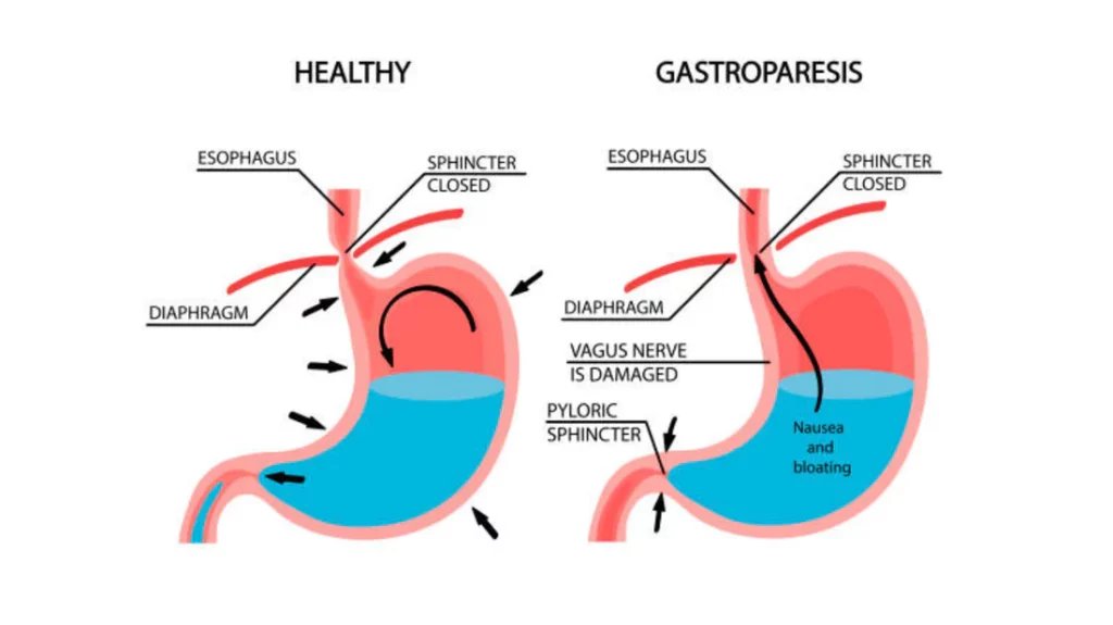 Gastroparesis_and_Natural_Food